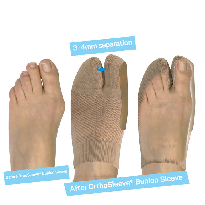 OS1st Bunion Brace HV3